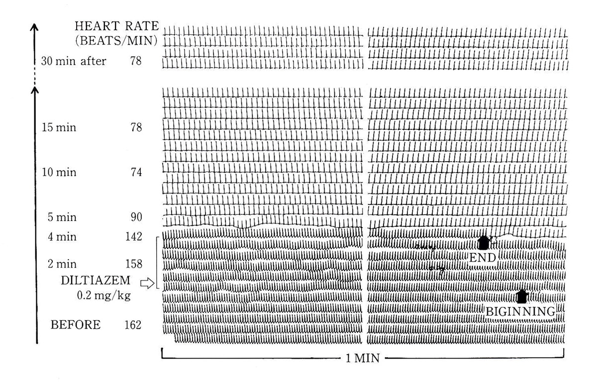 図1潜在性WPW症候群による発作性上室性頻拍(18歳男)に対するdiltiazem(0.2mg/kg)静注の効果