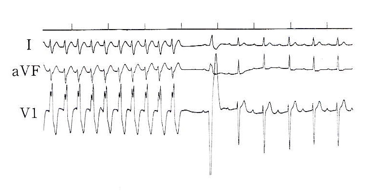 図3特発性心室頻拍(18歳男)のdiltiazem(0.2mg/kg)静注による停止
