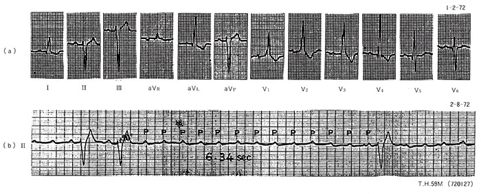 図5いわゆる二枝ブロックから三枝ブロックに進行した症例（症例3）、59歳、男性（720127）