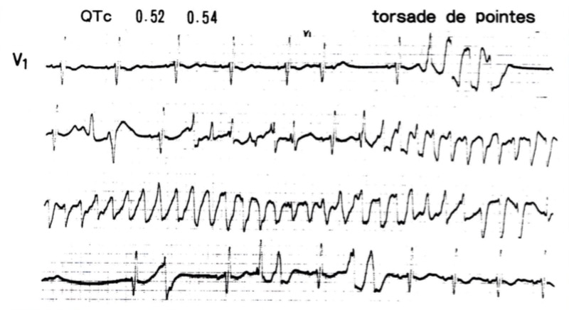 図2Romano-Ward症候群におけるtorsade de pointes